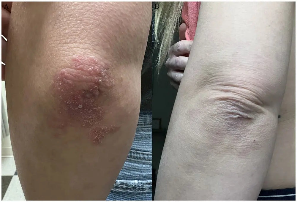 Before and after images from a 12-week Wake Forest Dermatology study participant showing improvement in psoriasis symptoms.