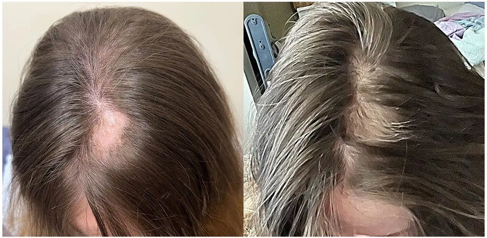 Before and after images from a 12-week Wake Forest Dermatology study participant showing improved hair coverage.